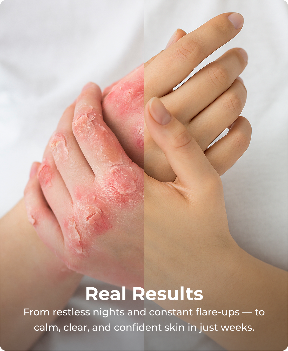 Sereni DermaGenesis™ Breakthrough Eczema & Psoriasis Relief